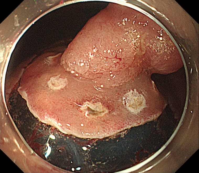 早期胃癌に対する内視鏡的粘膜下層剥離術