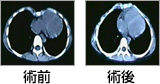 漏斗胸に対する矯正術