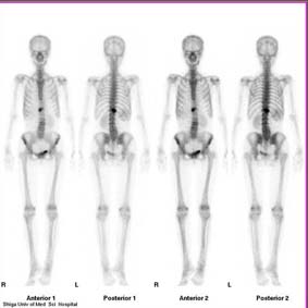 bone scinti