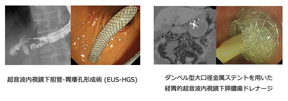 胆膵疾患の診断・治療