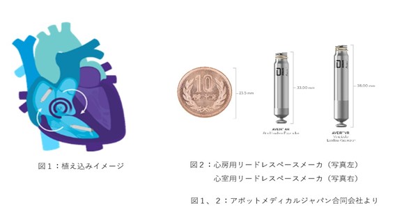 リードレスペースメーカを用いた心房・心室同期ペーシング治療
