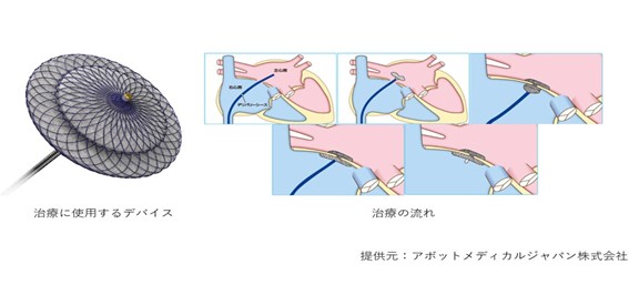 奇異性脳梗塞に対する経皮的卵円孔開存閉鎖術（経皮的PFO閉鎖術）
