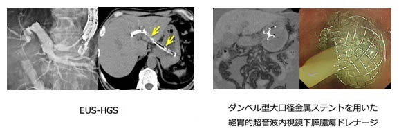 胆膵疾患の診断・治療