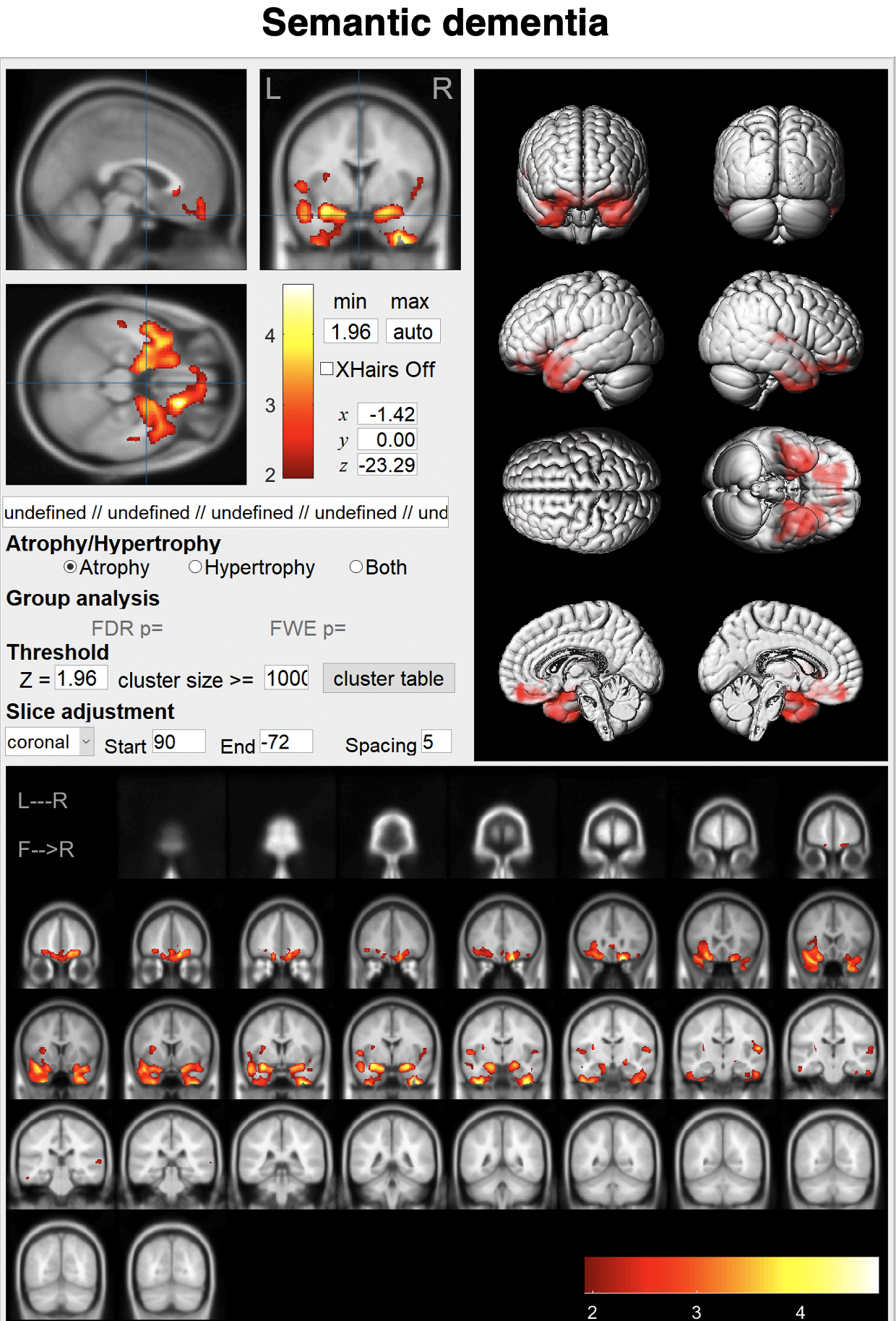 VBM for Semantic dementia