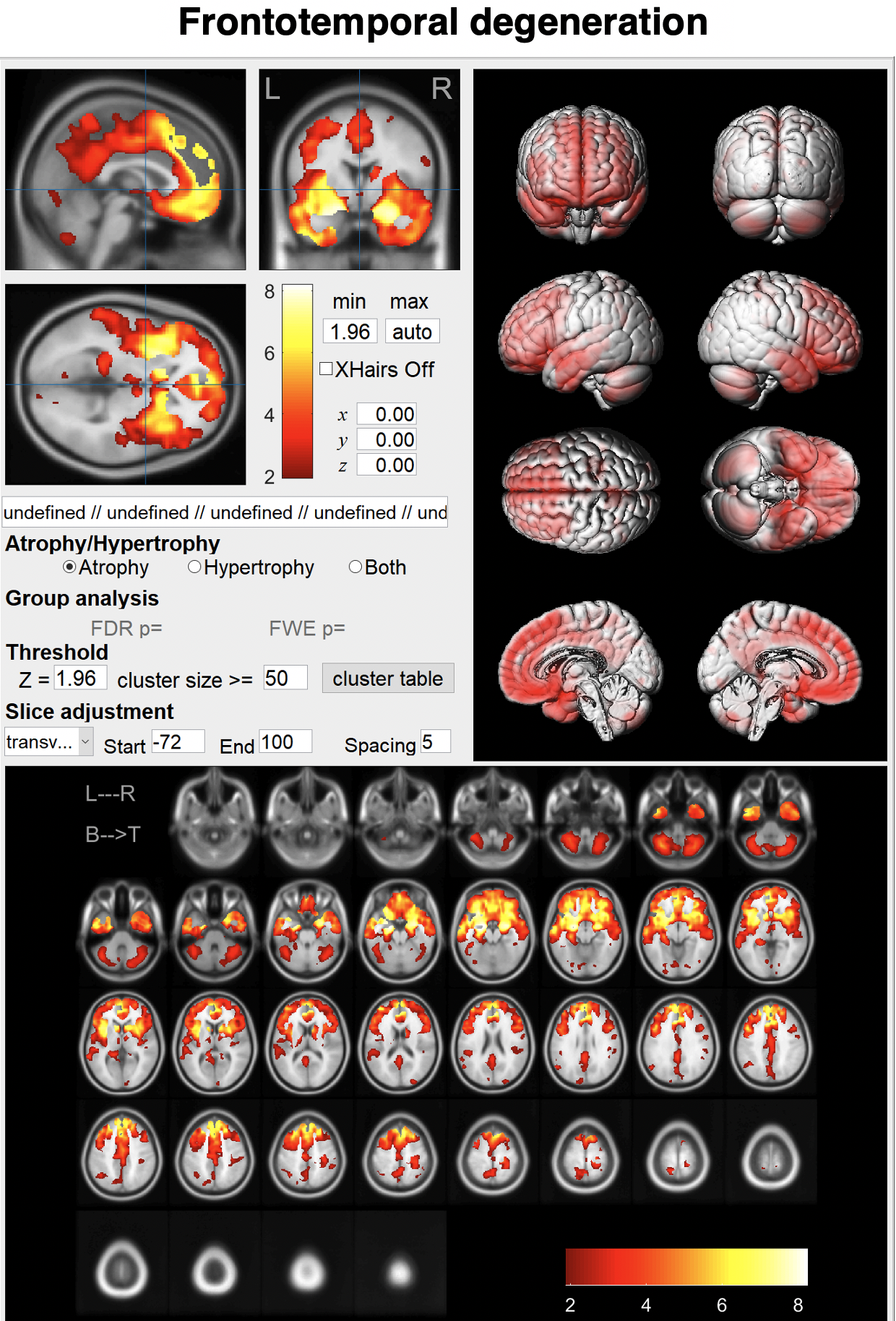 VBM for frontotemporal degeneration