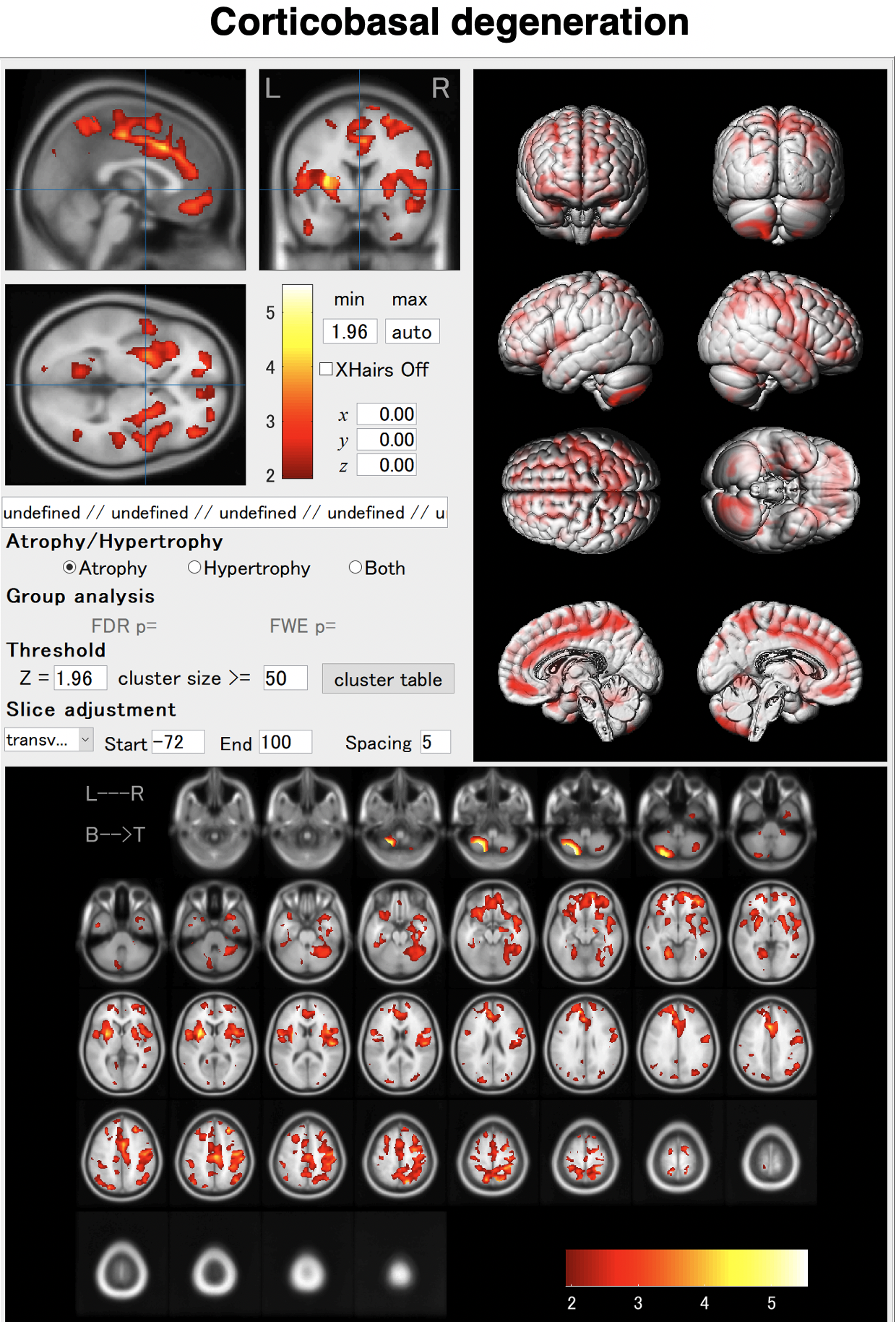 VBM for corticobasal degeneration