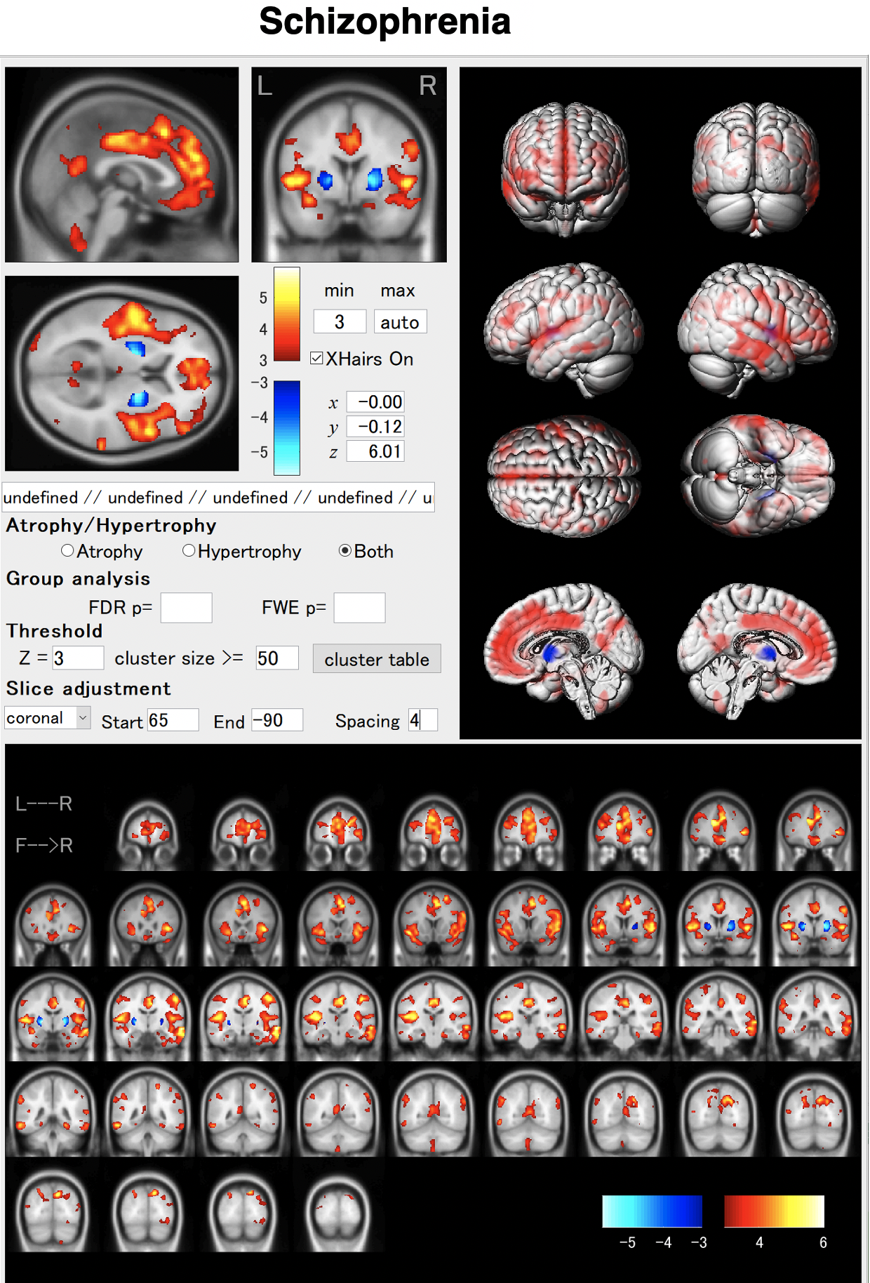 VBM for schizophrenia