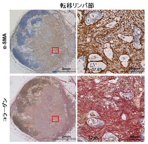 転移リンパ節の線維化は大腸癌における予後不良因子である