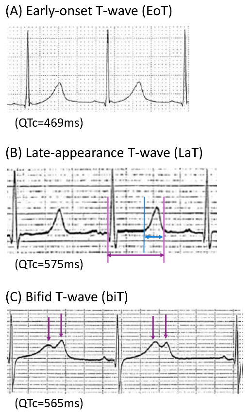 ［図２］LQT8患者の心電図に見られる3種のT波形状: (B)のlate-appearance T waveが一番多く全体の68%を占めています。