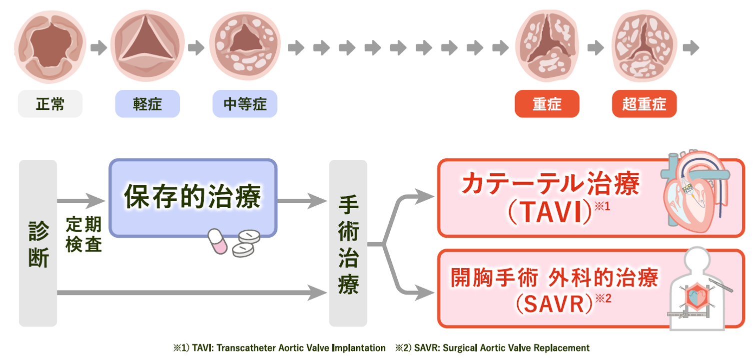 大動脈弁狭窄症の進行と治療の流れ（診断→保存的治療→手術治療：TAVIまたはSAVR）