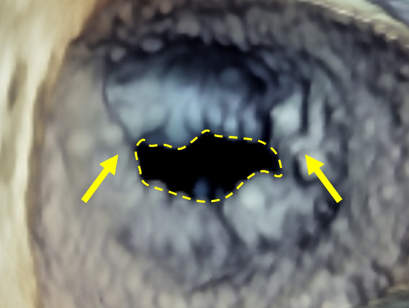 リウマチ性僧帽弁狭窄症(左心房側からの3D心エコー画像)