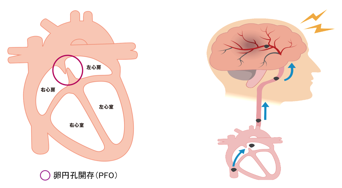 卵円孔開存（PFO）の位置と、右心房から左心房へ通り抜けた血栓が脳へ流れるイメージ