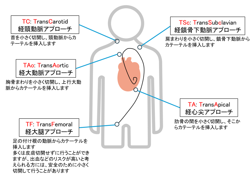 TAVIの5つのアプローチ部位（TC・TSc・TAo・TA・TF）